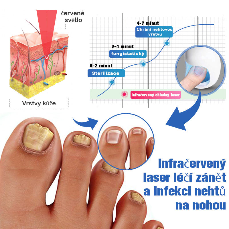 💎Furzero™ Hřebíky Fungus Čisticí laser Zařízení pro úlevu